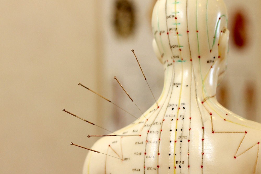 acupuncture2
